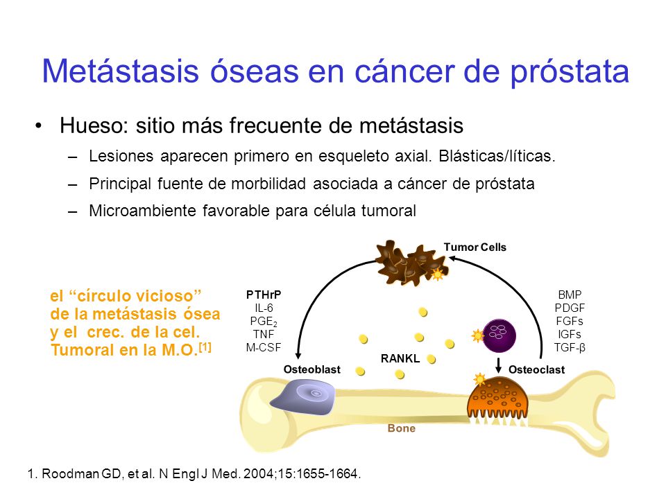el cáncer de próstata puede ir a los huesos